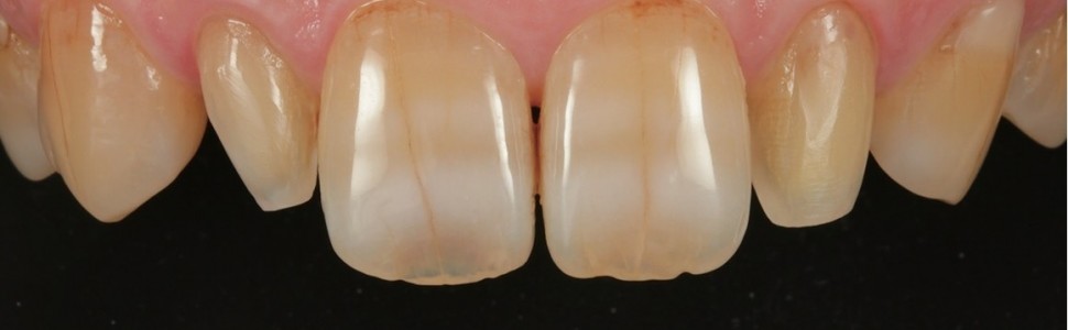 Odbudowa mikrodontycznych zębów siecznych bocznych szczęki (...)