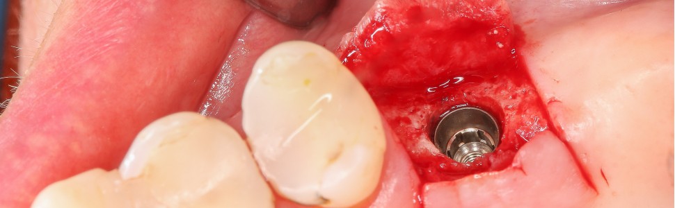 Podniesienie dna zatoki szczękowej metodą otwartą (...)