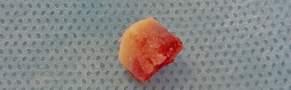 Technika pierścieni kostnych