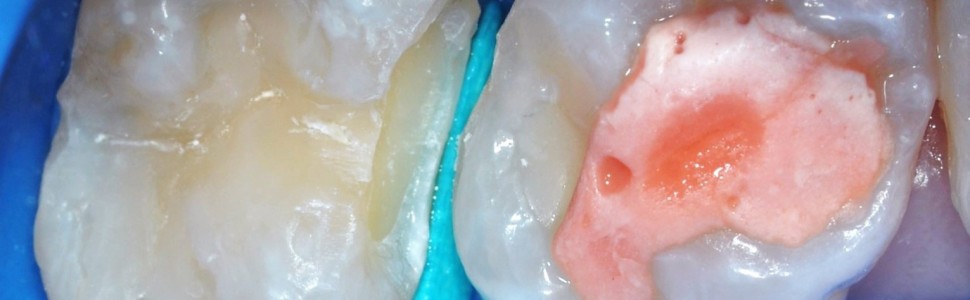 Nadwrażliwość pozabiegowa po wykonaniu wypełnienia kompozytowego (...)