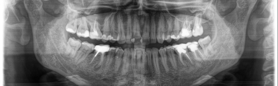 Ponowne leczenie endodontyczne – leczenie ze zmiennym scenariuszem (...)