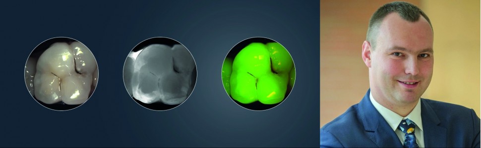 Dowiedz się więcej o technologii Near Infrared Laser Transillumination (NILT) w stomatologii zachowawczej