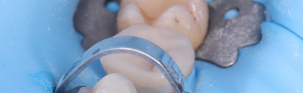 Nakład kompozytowy bezpośredni jako jedna z alternatyw (...)