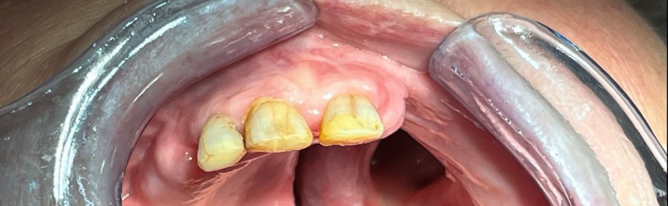 Rehabilitacja protetyczna pacjentów onkologicznych