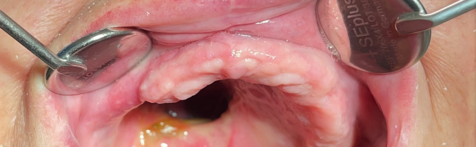 Rehabilitacja protetyczna po zabiegu częściowej resekcji szczęki