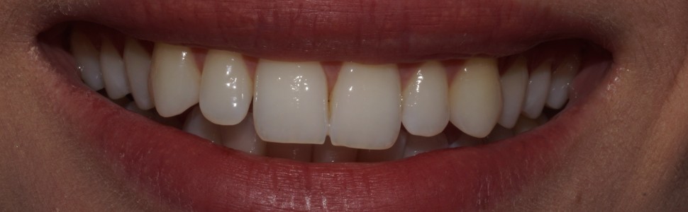 Estetyka uzupełnień protetycznych w przednim odcinku łuku zębowego