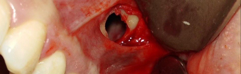 Torbiel zastoinowa lewej zatoki szczękowej o nietypowym przebiegu