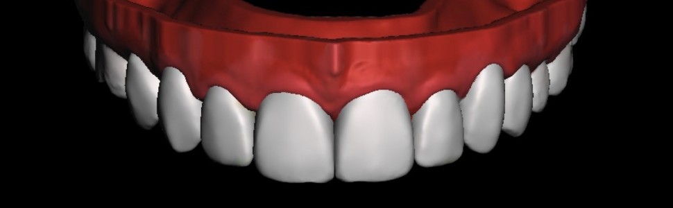 Flowable Injection Technique 