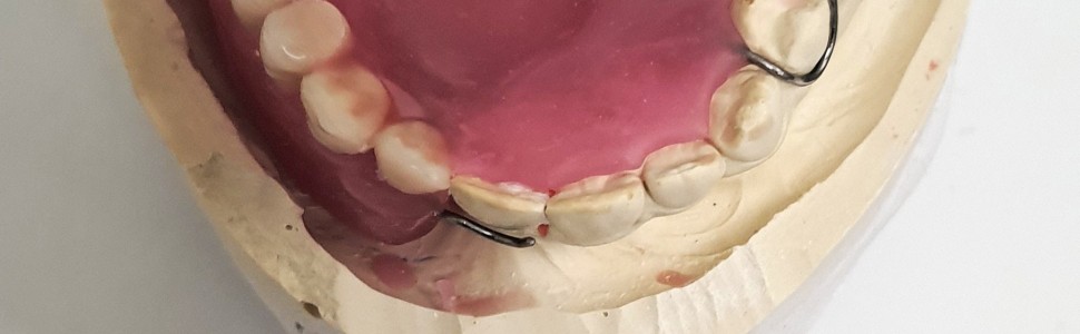 Rehabilitacja protetyczna u pacjentów z nabytym ubytkiem tkanek kości szczęk