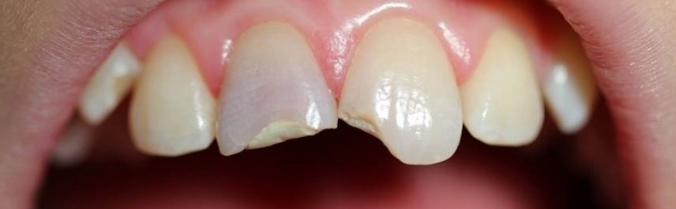 Złamania korzeni zębów w wieku rozwojowym