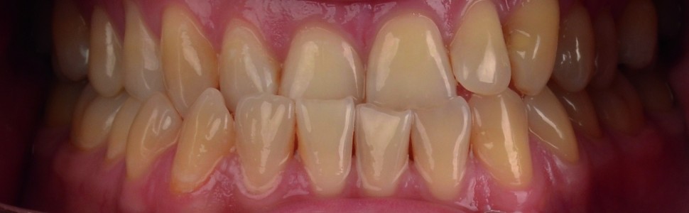 Poprawa estetyki uśmiechu po leczeniu ortodontycznym z wykorzystaniem płynnego kompozytu