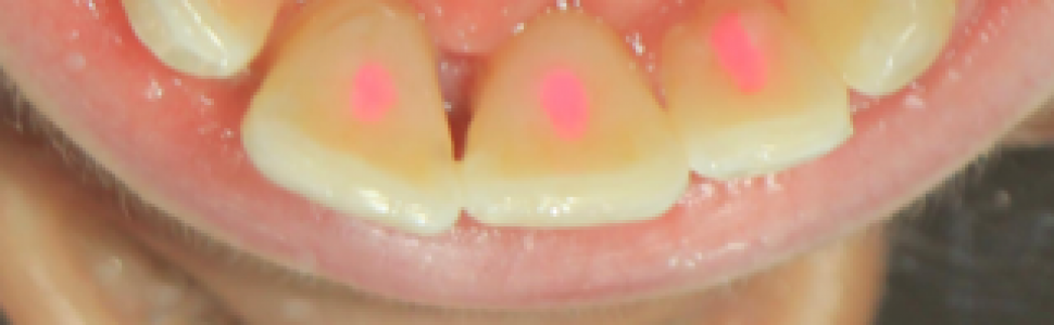 Leczenie endodontyczne przyśrodkowych i bocznych zębów siecznych szczęki