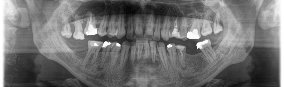 Jednowizytowe leczenie endodontyczne zębów 32 i 31