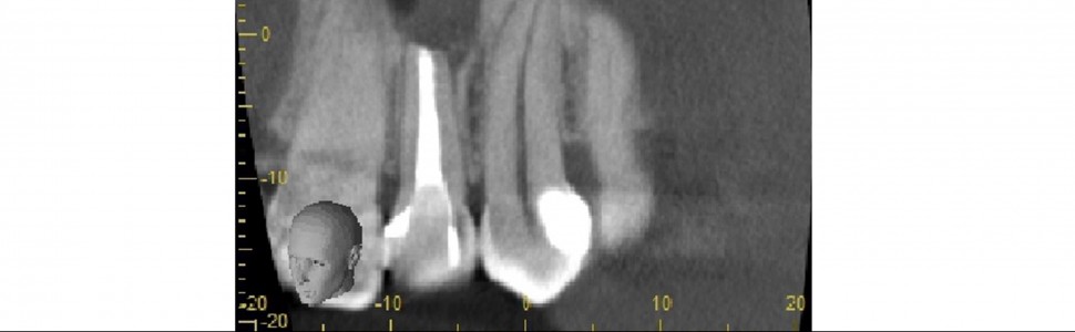 Wpływ etapowego leczenia endodontycznego wspomaganego procedurami mikrochirurgii