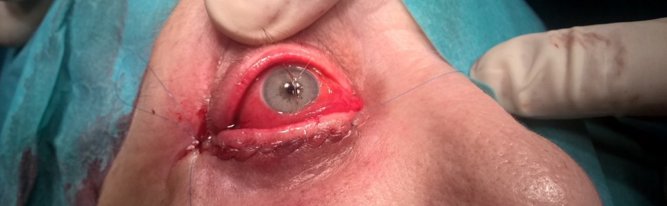 Niemetaliczne ciała obce oczodołu – opisy przypadków