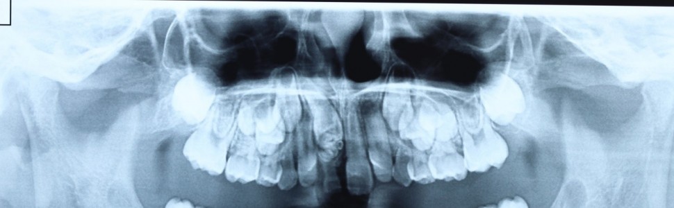 Zębiak zestawny – aktualny problem kliniczny