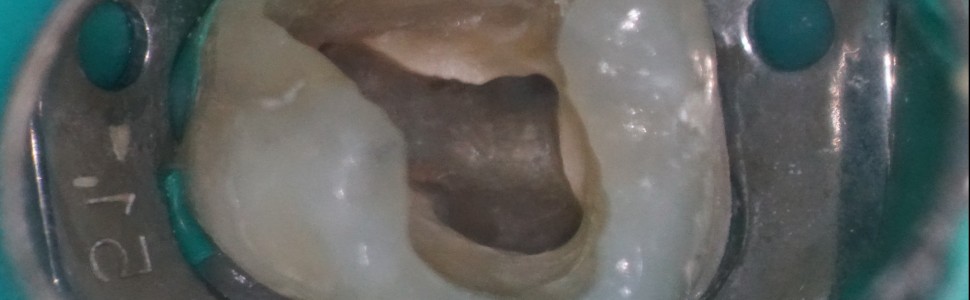Nietypowa anatomia kanałów korzeniowych spotykana w codziennej praktyce endodoncji mikroskopowej