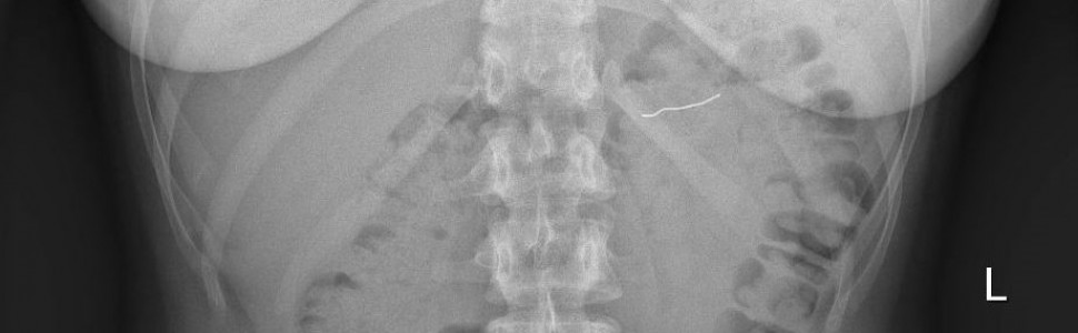 Przypadkowe połknięcie części aparatu ortodontycznego