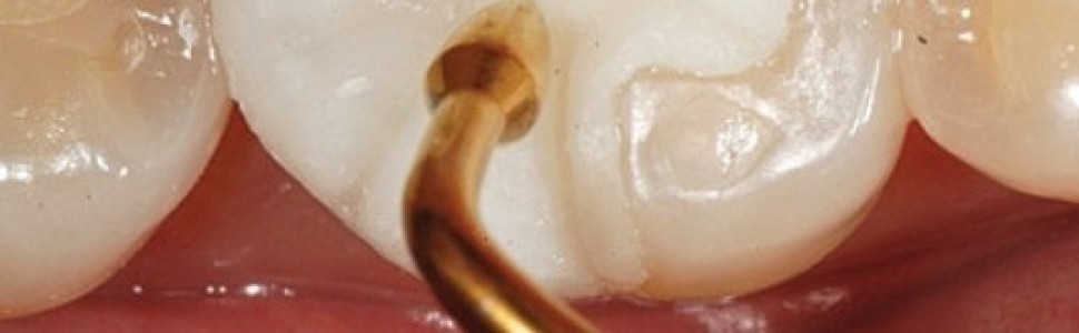 Immediate dentin sealing (IDS)