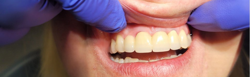 Powtórne leczenie endodontyczne 30 lat później