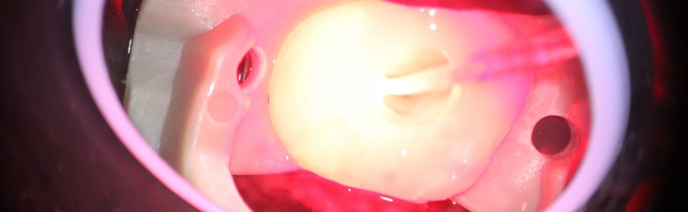 Powtórne leczenie kanałowe zęba 26 o nietypowej anatomii