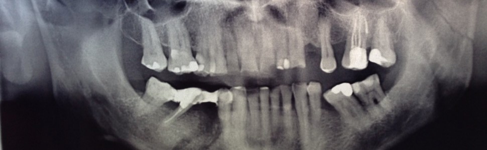 Leczenie pacjenta po urazie z utratą zęba 45 i pęknięciem żuchwy po obu stronach