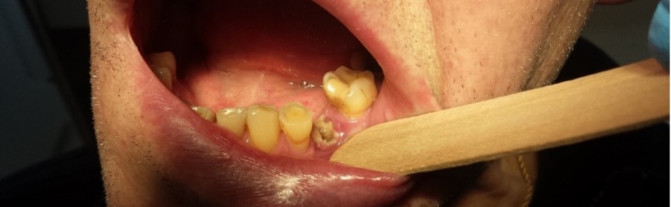 Wpływ leków antyresorpcyjnych na stan jamy ustnej
