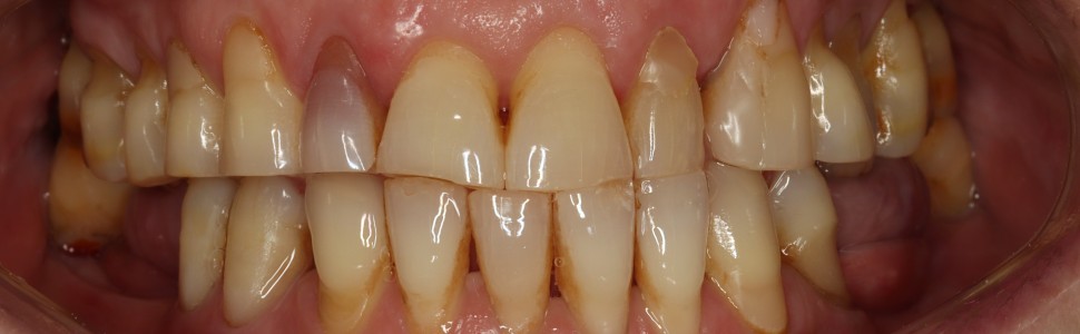 Wylew krwi do miazgi zęba jako następstwo urazu zgryzowego