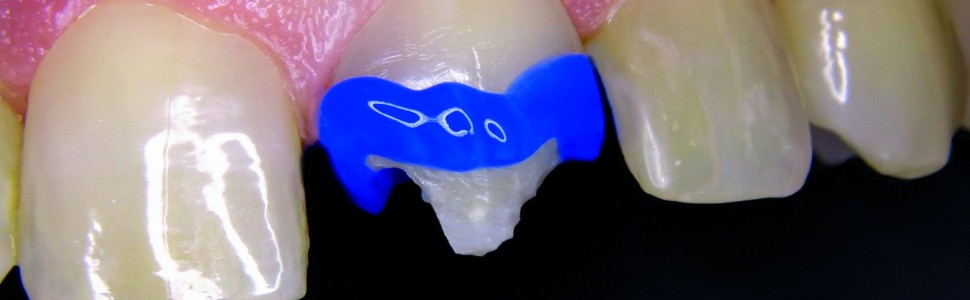 Odbudowa zębów przednich z wykorzystaniem innowacyjnej technologii ORMOCER®