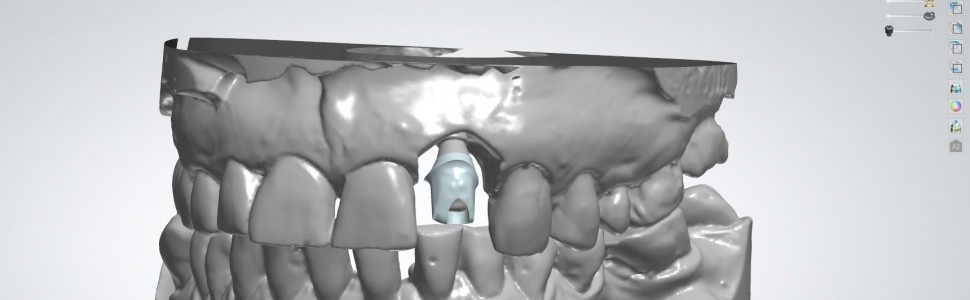 Zasady projektowania łączników protetycznych na śródkostnych wszczepach dentystycznych