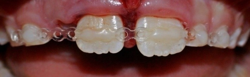 Ocena wiedzy lekarzy dentystów na temat szynowania zębów po urazie
