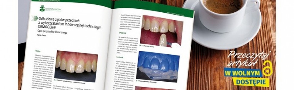 Odbudowa zębów przednich z wykorzystaniem innowacyjnej technologii ORMOCER® - artykuł w wolnym dostępie