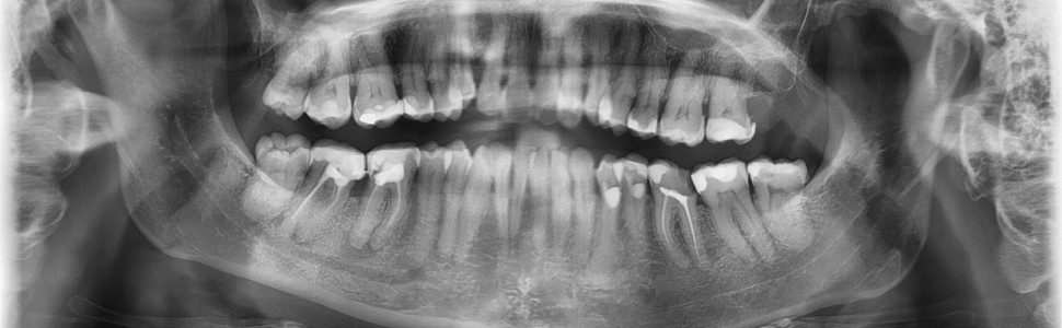 Gdzie endodonta nie może, tam uszczelniacz pośle – technika ciśnieniowa