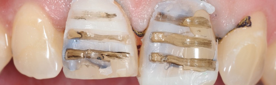 Cementowanie licówek na zębach siecznych centralnych z zastosowaniem PANAVIA™ V5