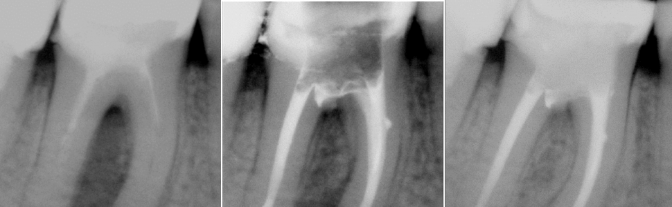 Leczenie perforacji dna komory zęba trzonowego żuchwy
