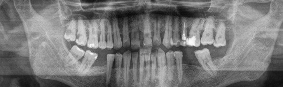 Leczenie endodontyczne zęba z szerokim otworem wierzchołkowym