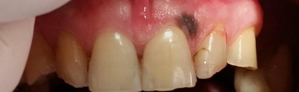 Diagnostyka i leczenie naczyniaka jamistego dziąsła szczęki