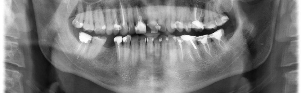 Kompleksowe leczenie endodontyczne, czyli jak poradzić sobie w trudnych sytuacjach klinicznych