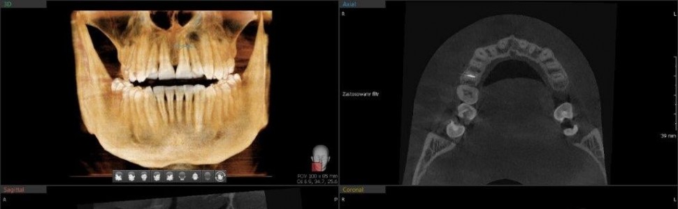 Uniknąć skalpela – endodontyczna  regeneracja kości 