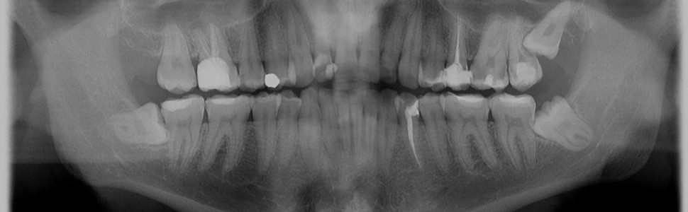 Diagnostyka resorpcji zewnętrznej  drugiego zęba trzonowego