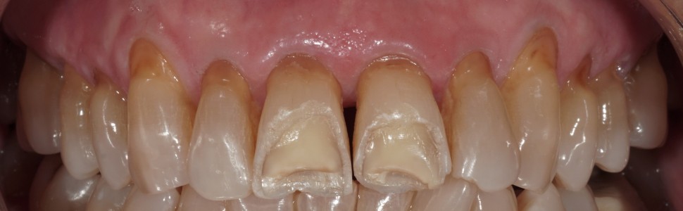 Jednostronne podniesienie zgryzu  z zastosowaniem mostu cyrkonowego