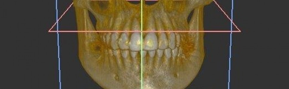 Analiza długości szwu podniebiennego  przy użyciu tomografii komputerowej  wiązki stożkowej