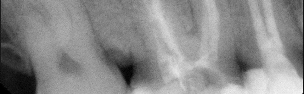 „Rogacz z doliny zatoki”, czyli pięciokanałowy pierwszy ząb trzonowy szczęki z dwoma kanałami podniebiennymi