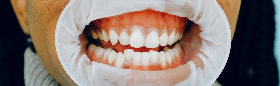 Czynniki decyzyjne dotyczące zastosowania bezpośredniego przykrycia miazgi