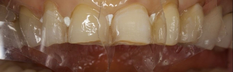 Technika Injection Flow: innowacyjne i minimalnie inwazyjne narzędzie 