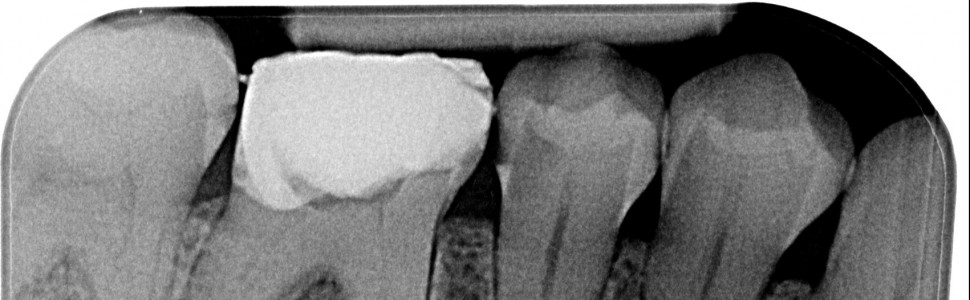 Leczenie endodontyczne czterokanałowego pierwszego zęba trzonowego żuchwy 