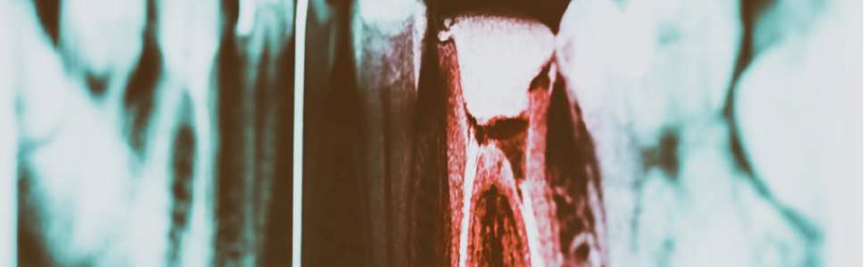 Leczenie endodontyczne zębów stałych niedojrzałych – Maria Barańska-Gachowska 