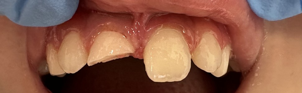 Leczenie endodontyczne zęba 11 z niezakończonym rozwojem korzenia – opis przypadku – Magda Skręty, Patrycja Ostrowska, Agnieszka Kus-Bartoszek, Aleksandra Wdowiak-Szymanik, Anna Jarząbek