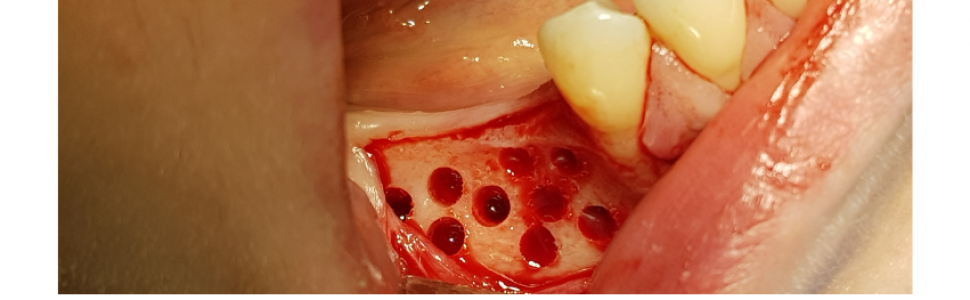 Artykuł w wolnym dostępie Opis przypadku. Augmentacja boczna wąskich wyrostków...
