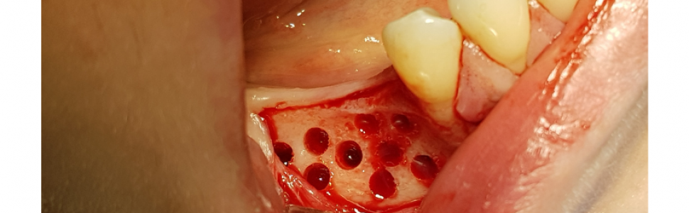 Augmentacja boczna wąskich wyrostków zębodołowych z zastosowaniem dwufazowego siarczanu wapnia – opis przypadku